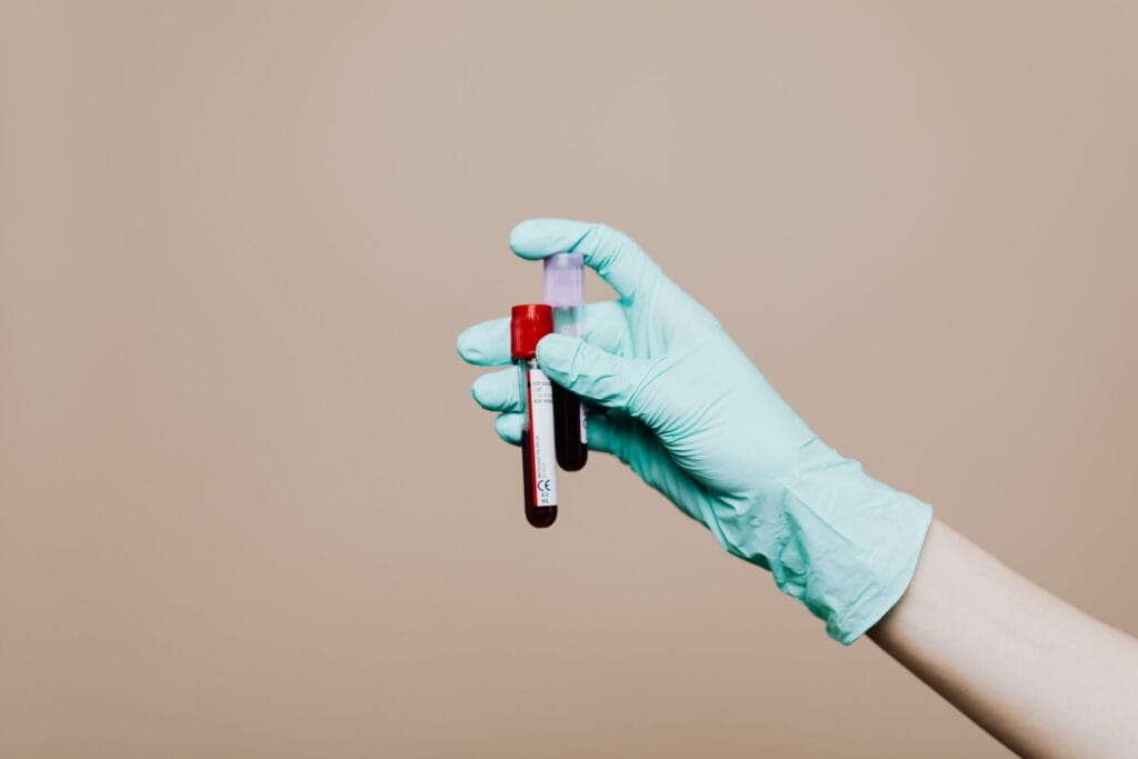 Blutprobe für einen Histaminintoleranz-Bluttest zur Bestimmung der DAO-Aktivität